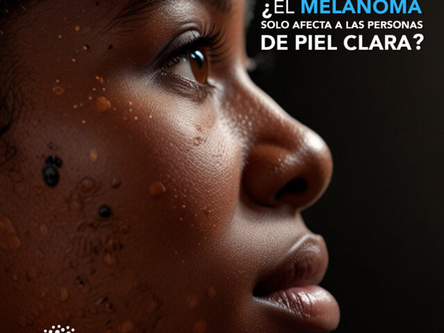 ¿El melanoma solo afecta a las personas de piel clara?